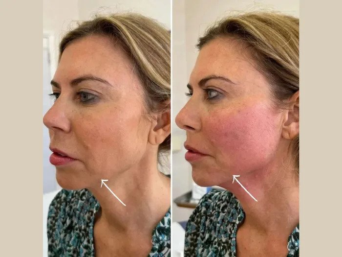 Best Aesthetic Clinics in dubai Offering Modern Endolift Laser Treatments