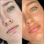 Dermal Fillers Injection in Dubai