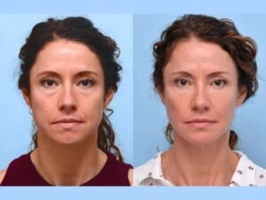 Best Aesthetic Clinics in Dubai for Natural-Looking Thread Lifts
