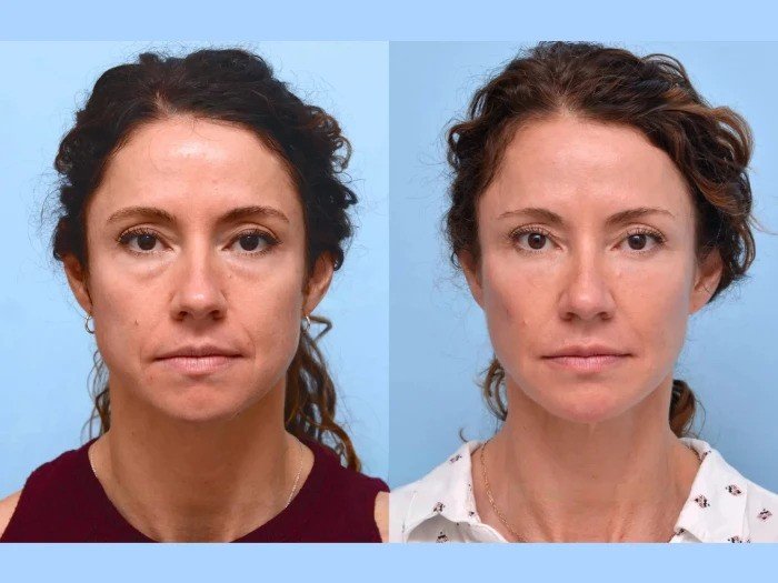 Best Aesthetic Clinics in Dubai for Natural-Looking Thread Lifts