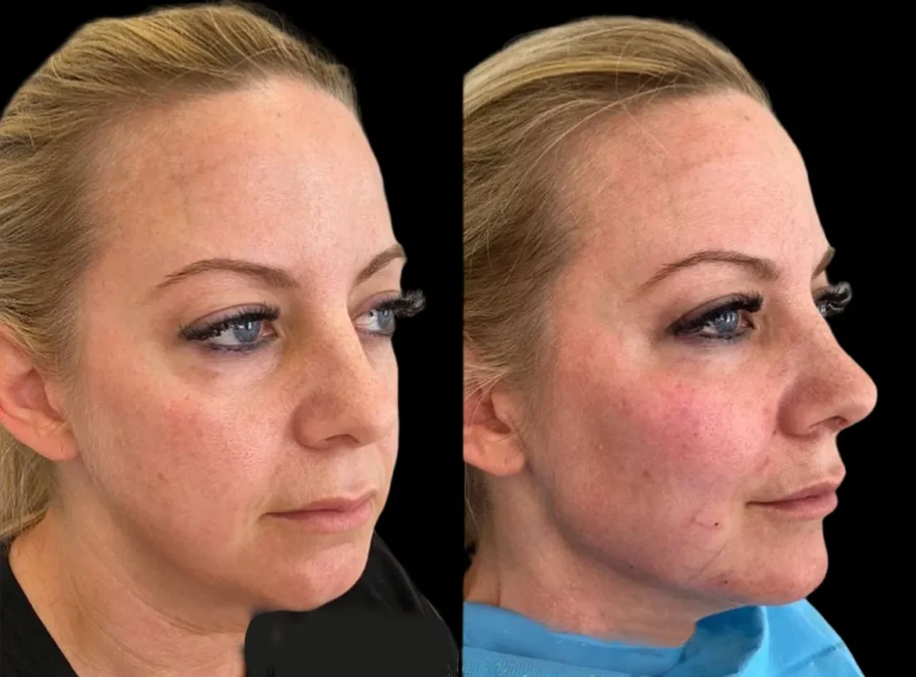 Cheek Fillers Injection in Dubai