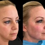 Cheek Fillers Injection in Dubai