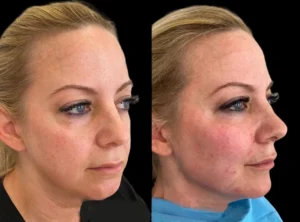 Cheek Fillers Injection in Dubai