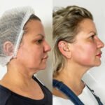Why Endolift Treatments in Dubai Is Ideal for Busy Lifestyles