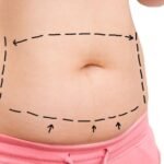Waist Sculpting Treatment in Dubai1
