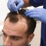 hair transplant in dubai