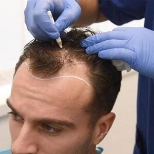 hair transplant in dubai