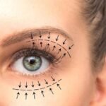 Upper Blepharoplasty In Dubai
