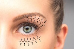Upper Blepharoplasty In Dubai