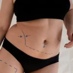 Lipo Suction Dubai