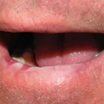 Actinic Keratosis Lips showing sun-damaged lips, persistent dryness, scaling, and changes in skin texture.