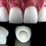 E-Max Veneers in Dubai1