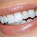 E-Max Veneers in Dubai9