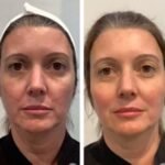 Best Aesthetic Clinics in Dubai for Thread Lift and Collagen Stimulation