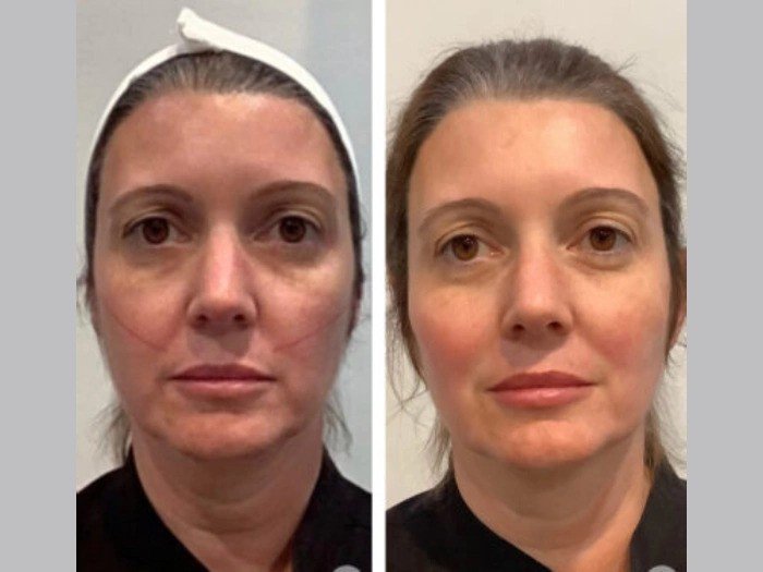 Best Aesthetic Clinics in Dubai for Thread Lift and Collagen Stimulation