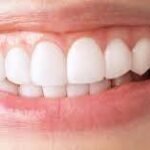 Home Teeth Whitening in dubai3