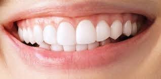 Home Teeth Whitening in dubai3