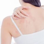 Skin Diseases Treatment in Dubai6