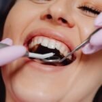 Teeth Polishing & Scaling in Dubai6