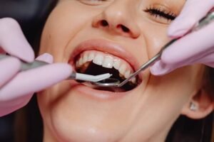 Teeth Polishing & Scaling in Dubai6
