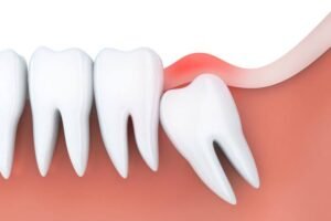 Wisdom Tooth Extraction in dubai4