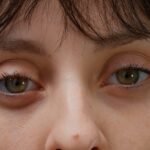 under-eyes-bags-removal-in-dubai
